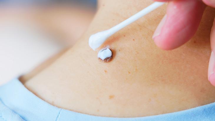 Lazerle aldıran da var, solüsyon süren de! ‘Her ben masum değil, incelenmeli’